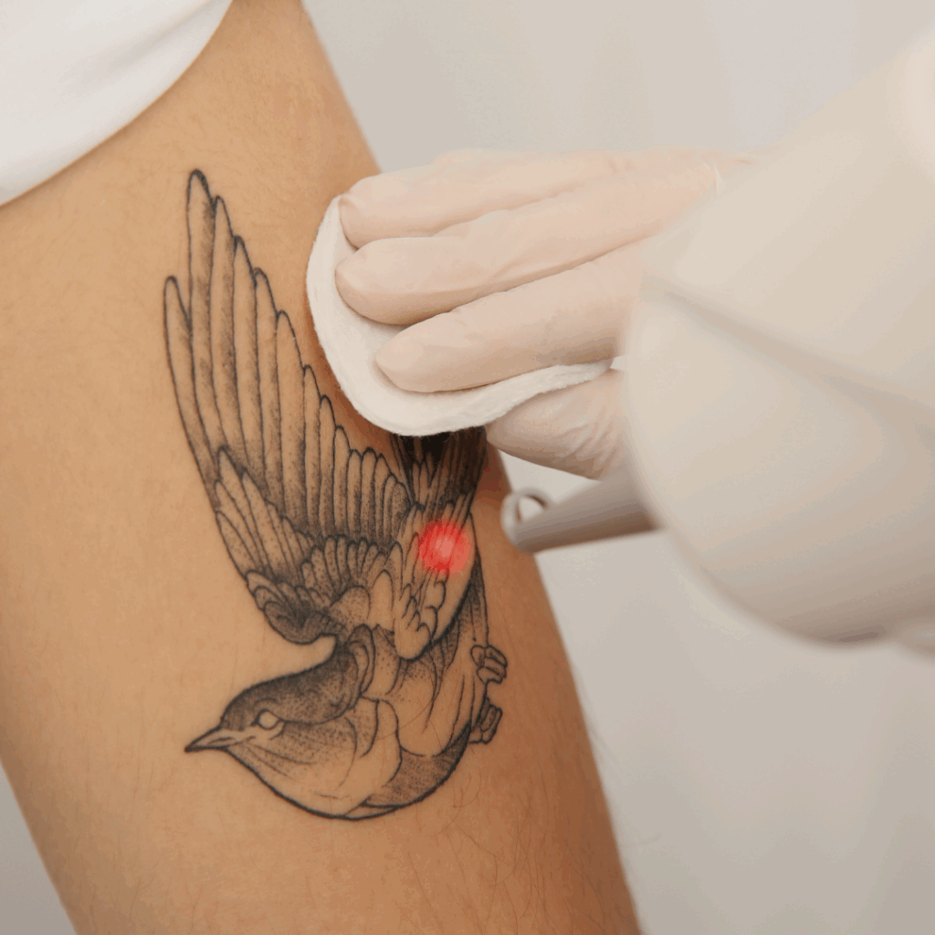 Systemen voor tatoeageverwijdering