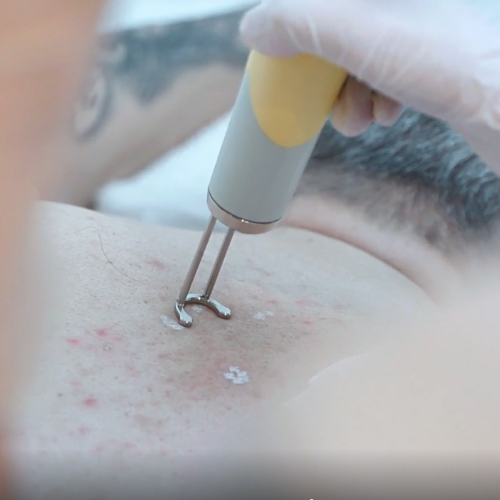 Asclepion NanoStar 2