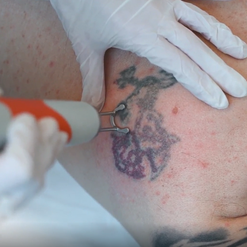 Asclepion NanoStar 3